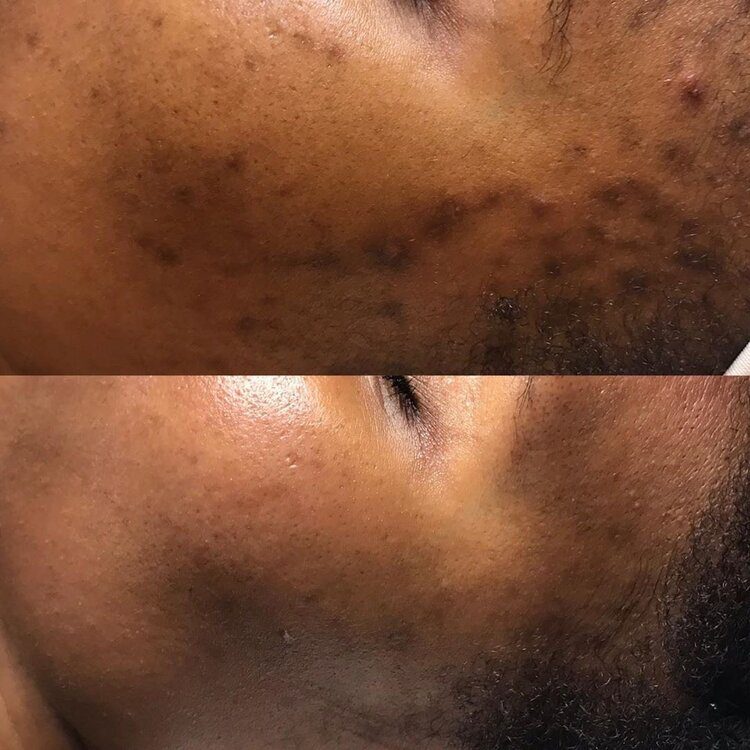 Before/after progress of consistent chemical peels from a SpaDerma patient of Christina Immordino.