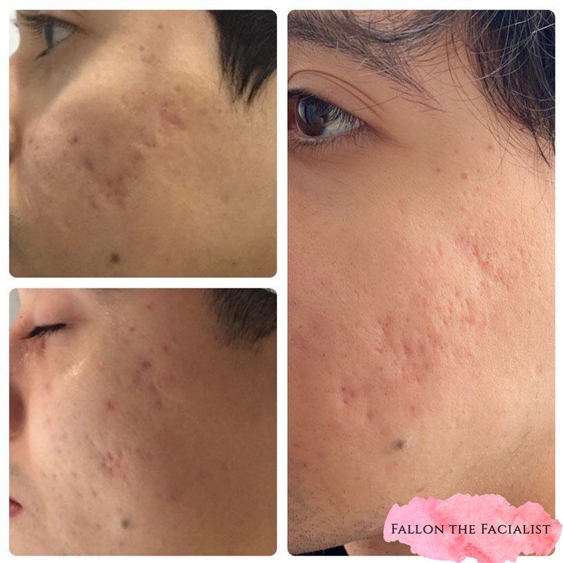 Microneedling progress! Treatments performed by Fallon Groh at SpaDerma Lakeview.